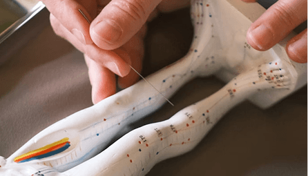 Acupuncture